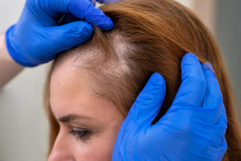 Mesotherapy for Hair