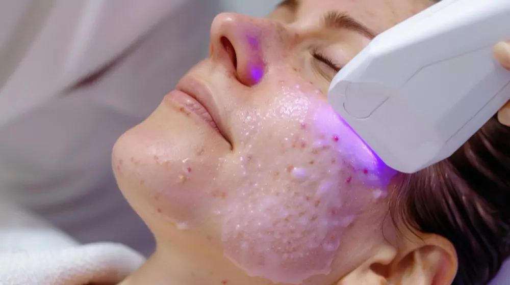 Laser Peels (for Pigmentation & Acne Scars)